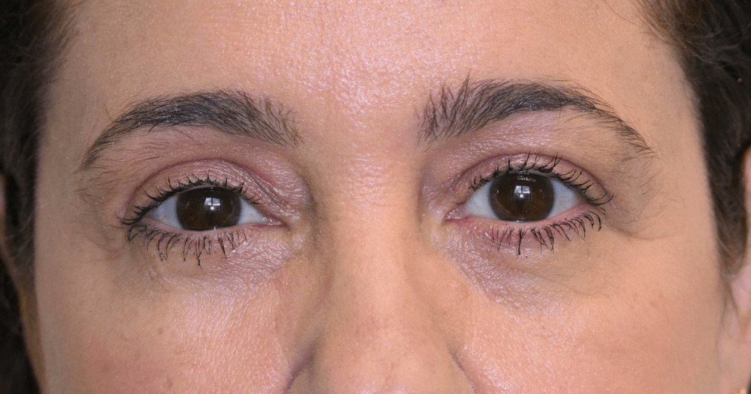 Case 01: the same patient’s upper eyelids after Ziplyft