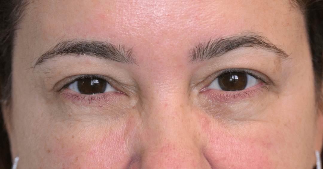 Case 01: a patient’s upper eyelids before Ziplyft