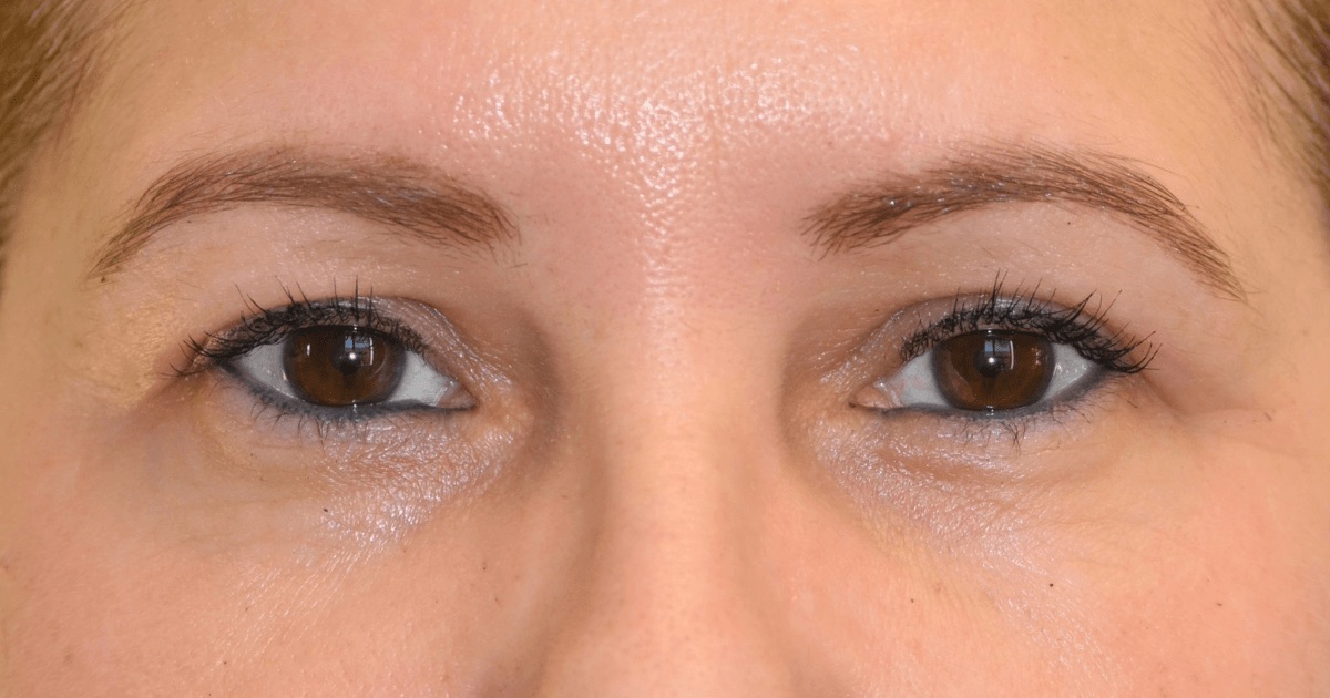 Case 03: the same patient’s upper eyelids after Ziplyft
