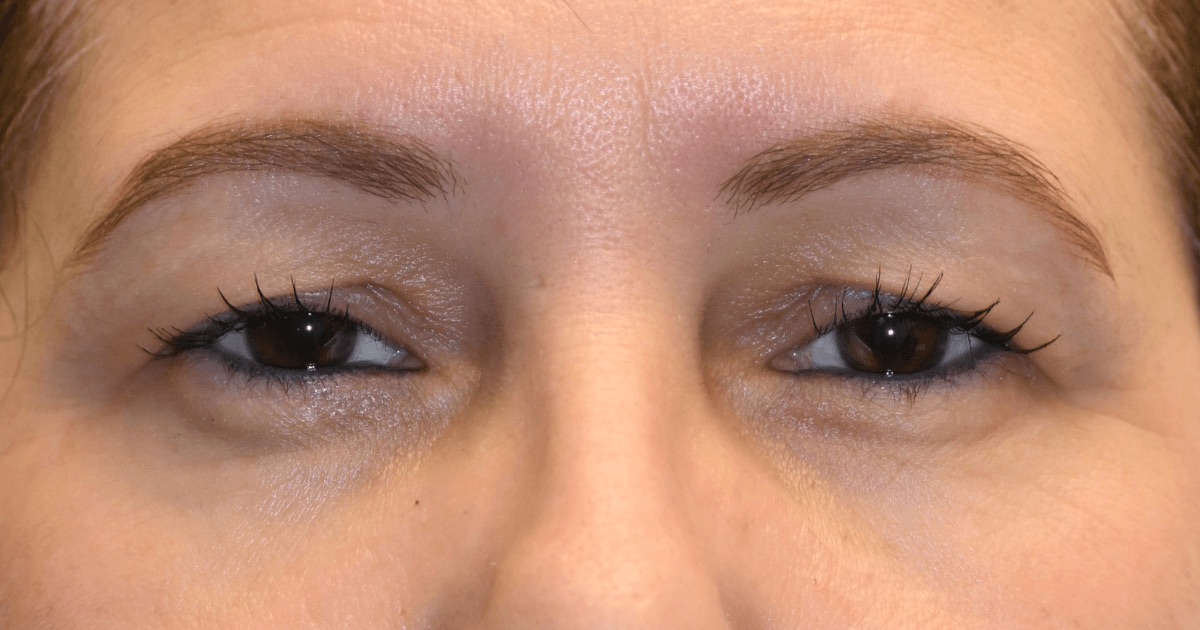 Case 03: a patient’s upper eyelids before Ziplyft