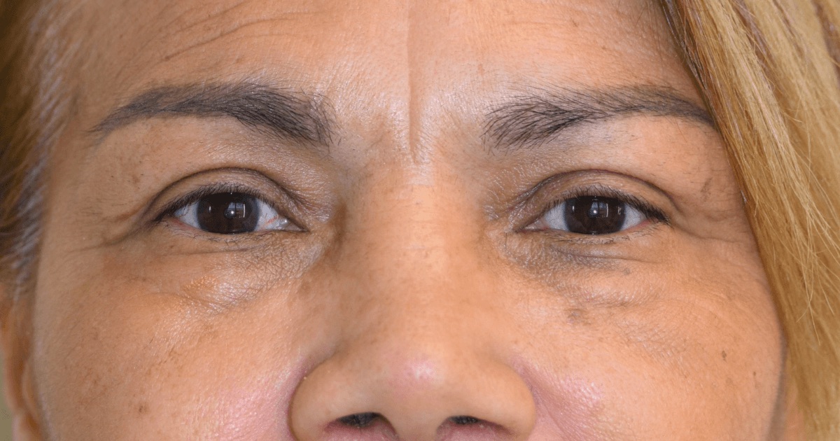 Case 06: the same patient’s upper eyelids after Ziplyft