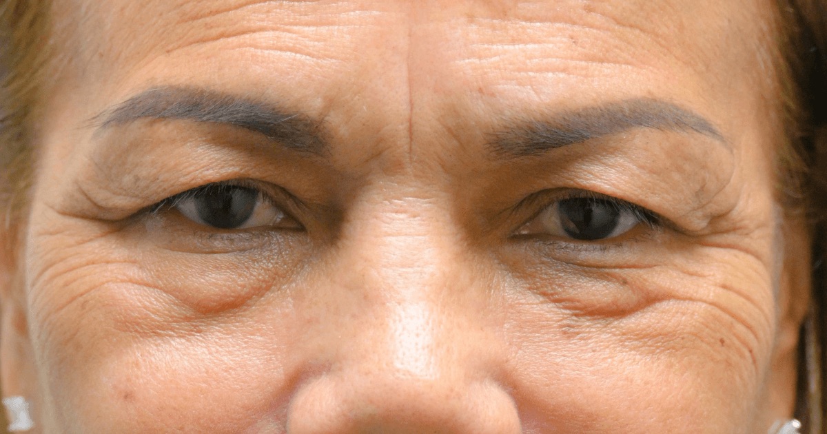 Case 06: a patient’s upper eyelids before Ziplyft