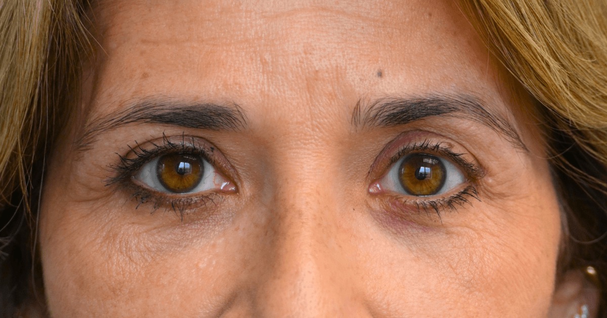 Case 08: the same patient’s upper eyelids after Ziplyft
