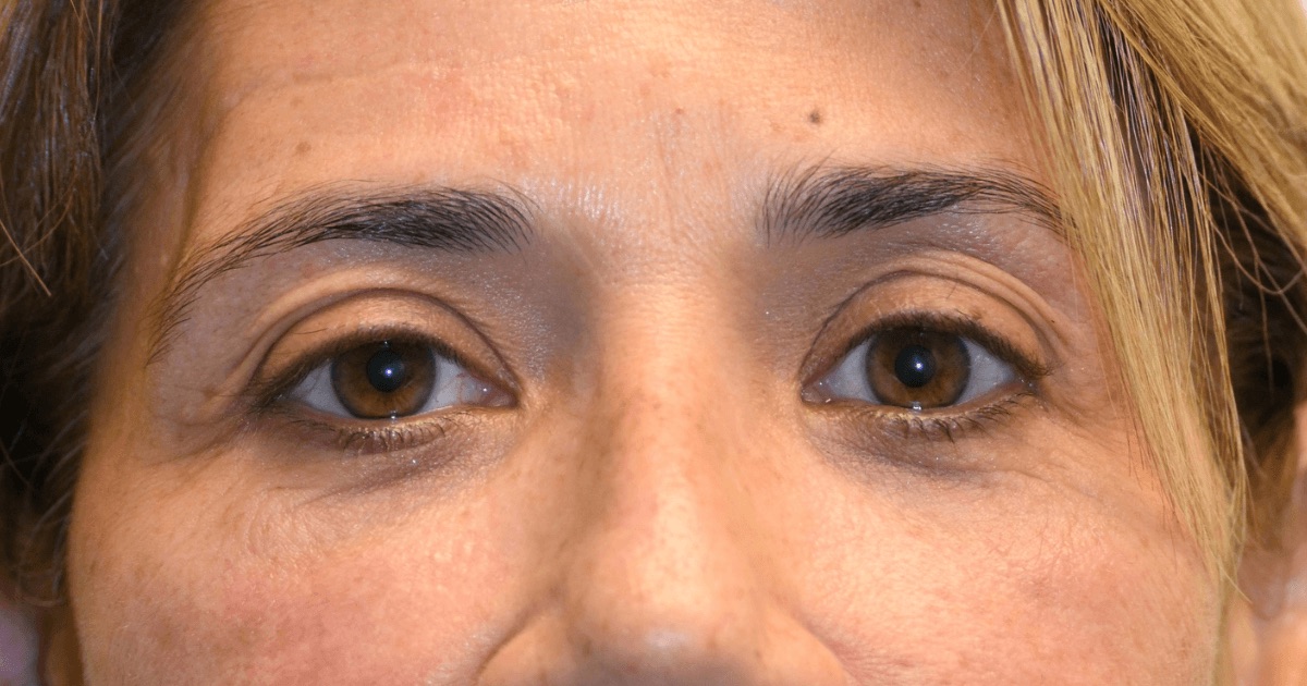 Case 08: a patient’s upper eyelids before Ziplyft
